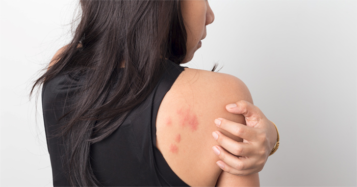 <b>Atopic Dermatitis (Eczema)  - Multiple Locations in the US</b>