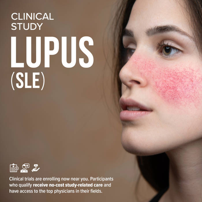 <b>Lupus - Multiple Locations in the US</b>