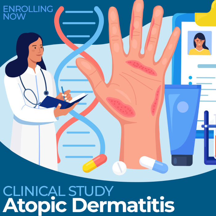 <b>Atopic Dermatitis (Eczema) - Multiple Locations in the US</b>